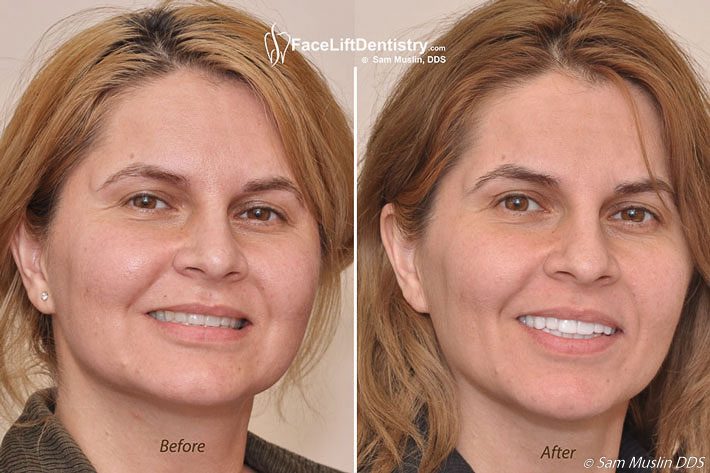 This Is Why You Need An Overbite Correction